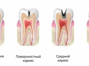 Как выбрать детскую зубную пасту?